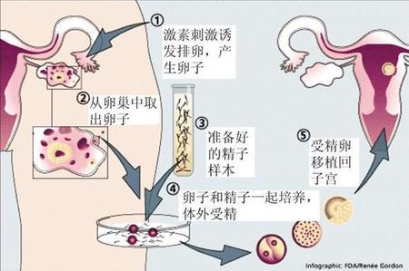 爱心供卵助孕咨询怎么收费